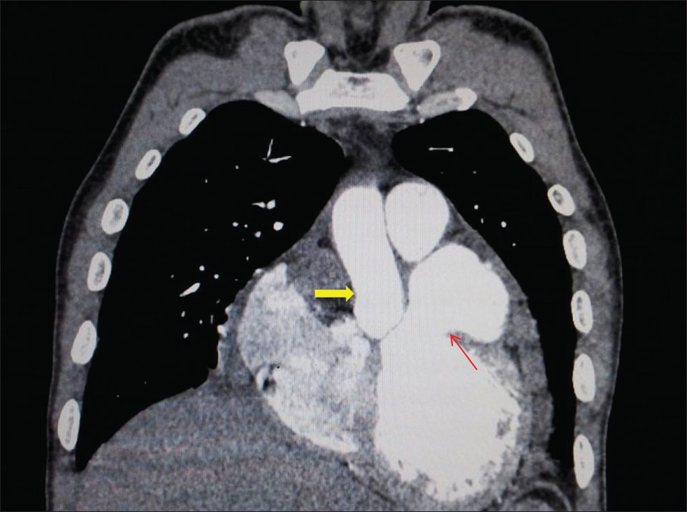 Coronal image of CT aorta angiogram shows the pooling of contrast into a thin-walled protrusion arising from the anterolateral part of left ventricular wall (thin red arrow) abutting the proximal portion of ascending aorta (solid yellow arrow).