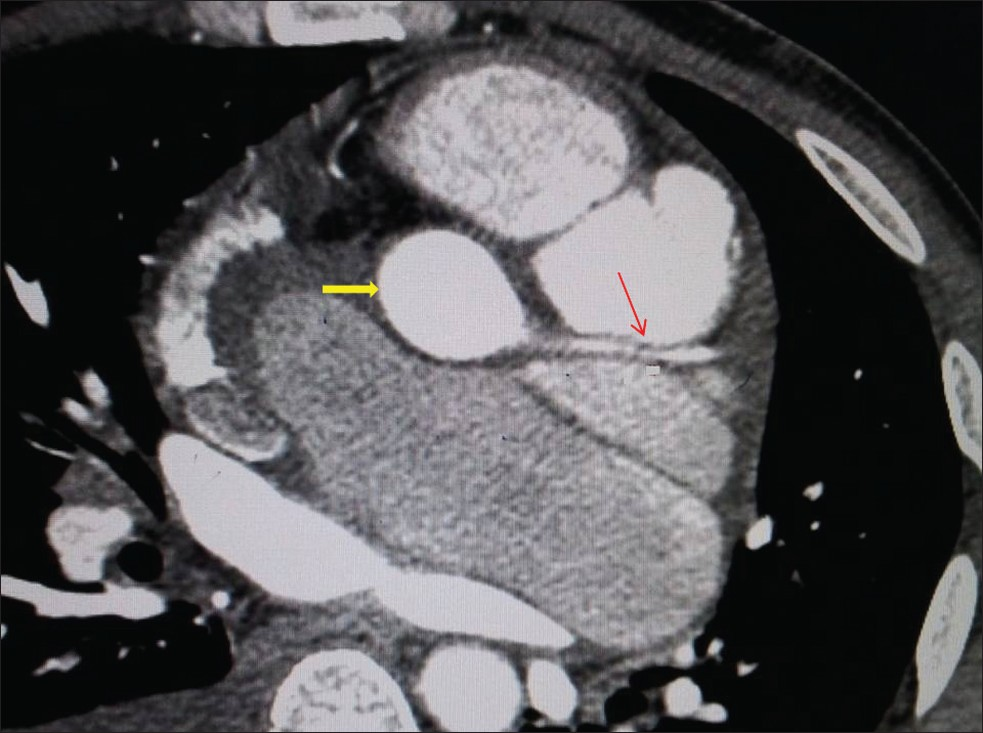 Contrast-enhanced axial CT shows the displacement of left aortic sinus (bold yellow arrow) and left coronary artery (thin red arrow).