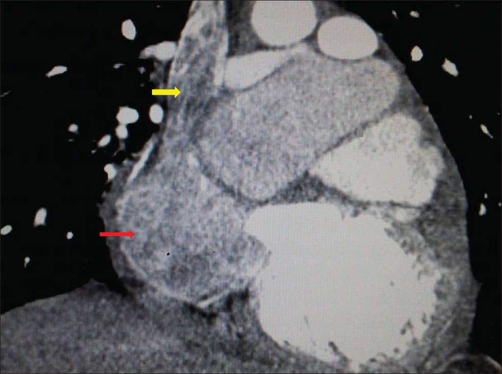 Coronal-reformatted CT angiogram image demonstrates a large thrombus in the right atrium (bold red arrow) extending into the superior vena cava (bold yellow arrow).