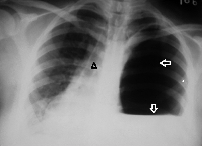 Left tension gastrothorax. Chest X-ray of a 28-year-old pregnant female shows herniation of the stomach into the left hemithorax (horizontal arrow), with air fluid level (vertical inverted arrow) and mediastinal shift to the right side (arrow head).