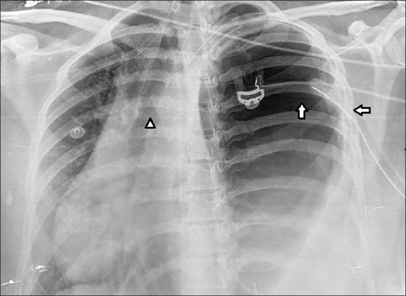 Left tension gastrothorax with left intercostal drain. Chest X-ray of a 28-year-old pregnant female shows herniation of the stomach into the left hemithorax (vertical arrow), with intercostal drain (horizontal arrow) and mediastinal shift to the right side (arrow head).