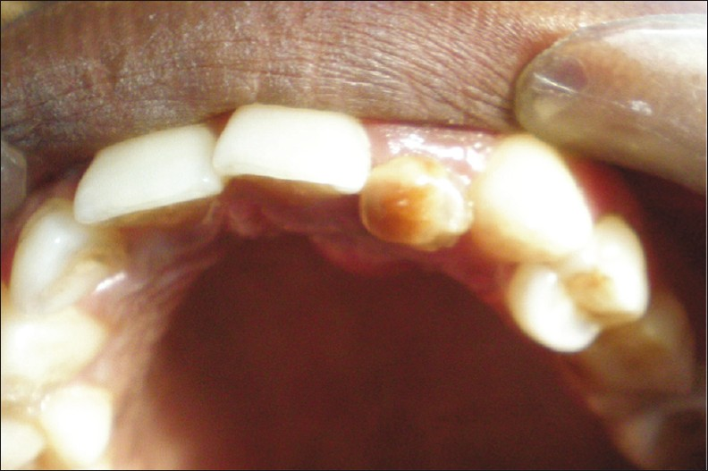 Photograph shows discoloration and malformation of the left lateral incisor.