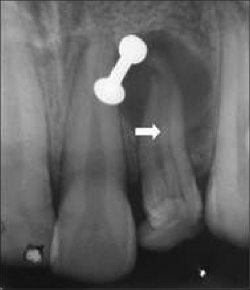 Radiograph shows presence of an invagination along the entire length of the root (white arrow). The white object in the image is the patient's nose ring which was difficult to remove when taking the radiograph.