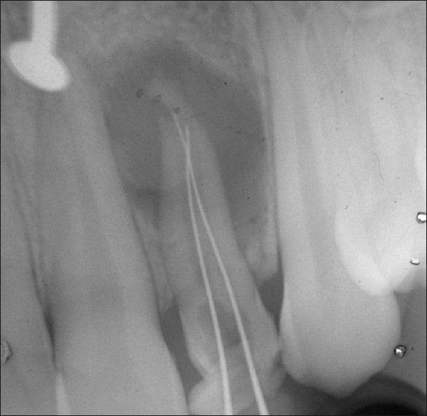 Working length radiograph confirms the presence of two separate root canals.