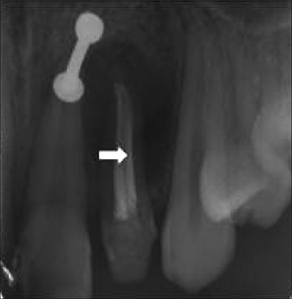 Post-obturation radiograph shows a dentine bridge along the entire length of the root canal (white arrow).