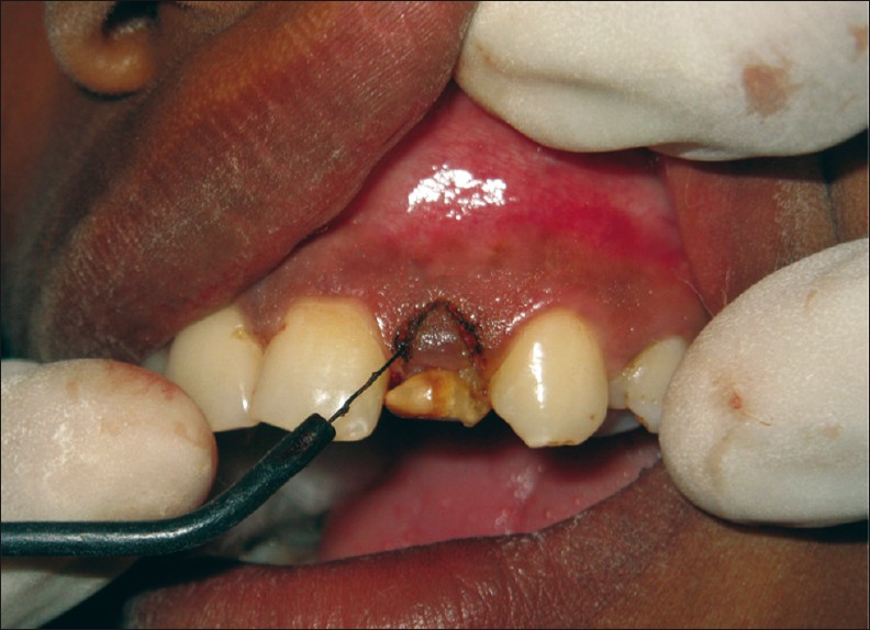 The image shows the lengthening of the crown done with electrocautery.