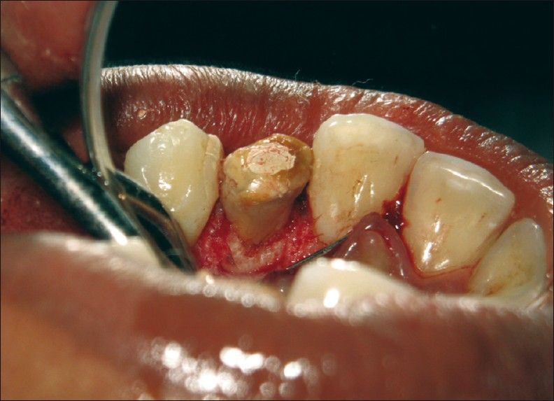 The image shows the palatal and labial groove sealed with light cure glass ionomer cement.