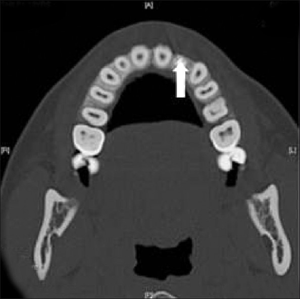 Computed tomographic (CT) view of the maxilla reveals two obturated canals (white arrow).