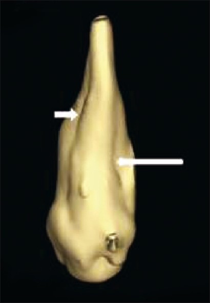 Three dimensional reconstruction of the involved tooth shows developmental groove along the entire length of the root, both labially and palatally (white arrows).