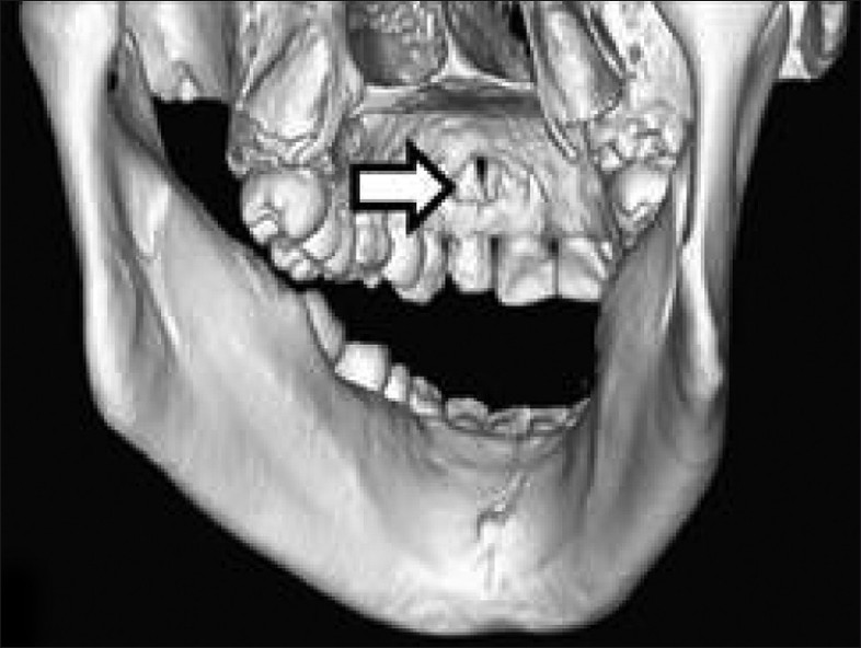 CT image shows a bony lesion with eroded palatal and labial cortical plates.