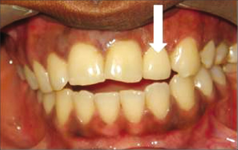 The photograph shows the tooth (white arrow) with a permanent ceramic crown.