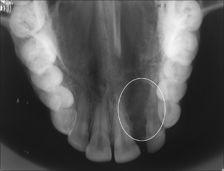 peripheres ossifizierendes Fibrom