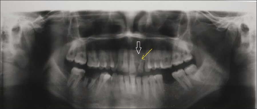 An orthopantomograph reveals a well-circumscribed unilocular radiolucency (broad arrow) and a displaced lateral incisor (thin arrow).