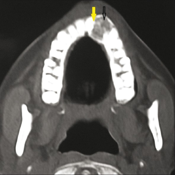 CT Para nasal view shows an expansile lesion with well-demarcated margins and area of calcification (black arrow) in the left maxilla with a displaced maxillary left lateral incisor (yellow arrow).