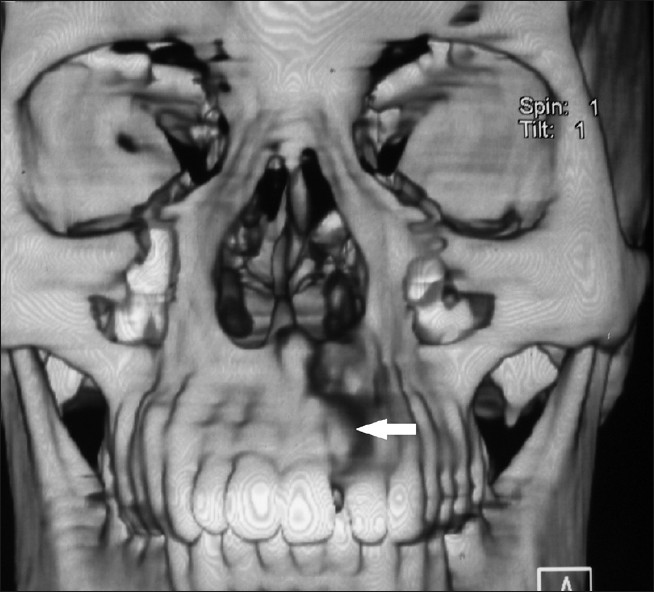 3D CT reveals an expansile lesion (white arrow) on the alveolar surface of the maxilla.