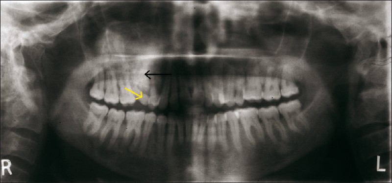 An orthopantomogram reveals diffuse radiolucency with areas of radiopacity (black arrow) in the region of right maxillary canine to molar region. Maxillary right second premolar (yellow arrow) appears to be displaced.