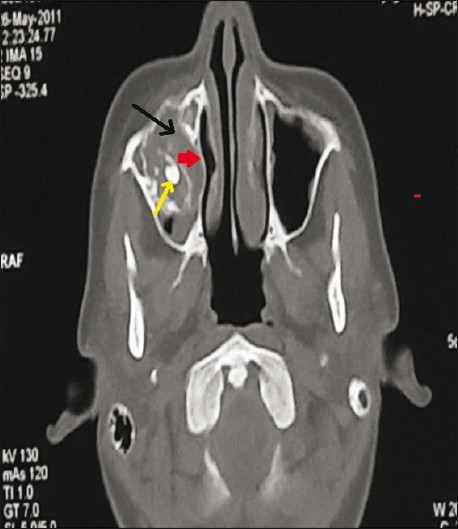 CT axial view shows a well-defined expansile lesion (black arrow) with sclerotic margin (red arrow), scattered amorphous calcification and teeth within the lesion (yellow arrow).