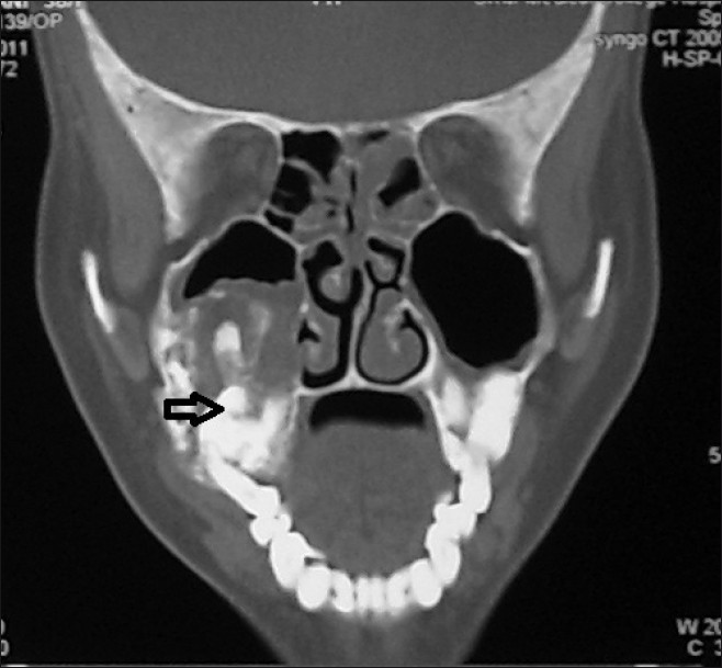 CT coronal view shows an expansile lesion in the right maxilla exhibiting features of calcification, presence of teeth displaced due to the lesion (black arrow) and involving the floor of the maxillary sinus.