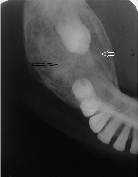 Mandibular occlusal radiograph of right side reveals the expansion of buccal (black arrow) and lingual (white arrow) cortical plates.