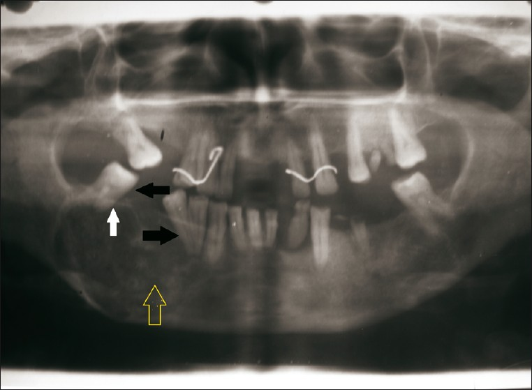 Orthopantograph reveals a mixed radiolucent-radiopaque lesion (yellow arrow) extending from mandibular first premolar to molar region. The image shows displacement of mandibular right second molar and second premolar (black arrow). There is evidence of root resorption in mandibular right second molar (white arrow).