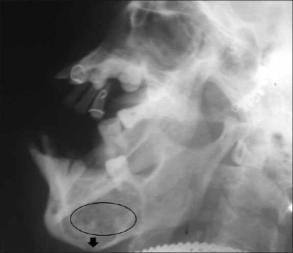 Right lateral skull radiograph shows mixed radiolucent and radiopaque lesion (circle) surrounded by a corticated border in relation to posterior mandible. There is thinning and bowing of the inferior border of the mandible (black arrow).