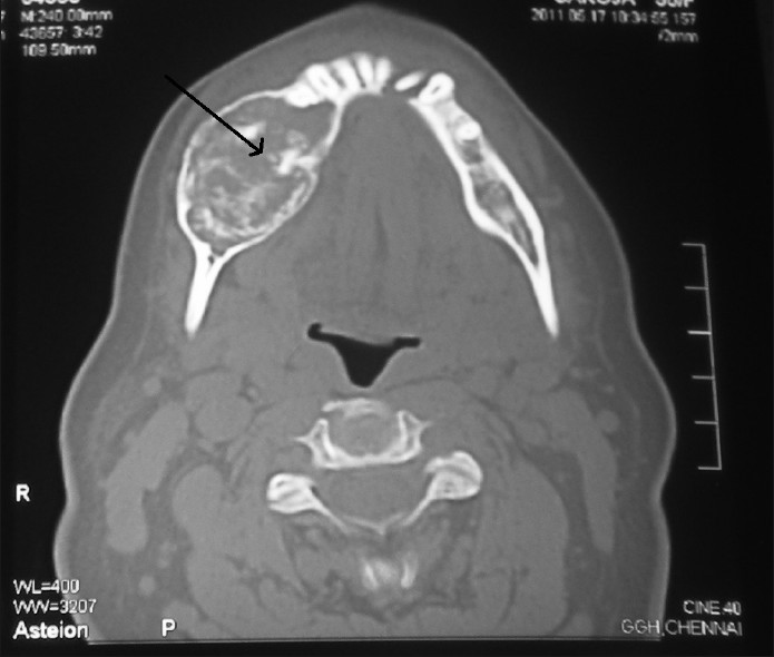 CT axial view shows an expansile lesion in the right mandible with equidirectional expansion, the margins are intact and there is a non-coalescing foci of mineralisation (black arrow).