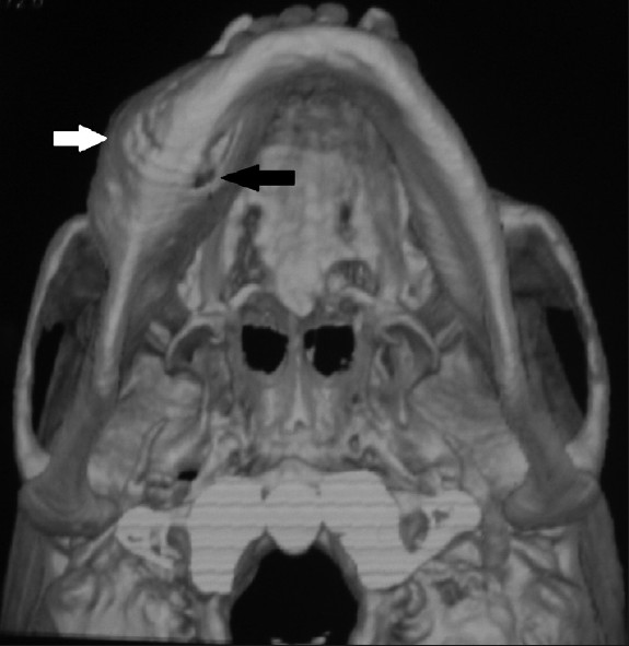 3D CT reveals abnormality in the right mandible with expansion of the buccal (white arrow) and lingual cortical plates (black arrow).