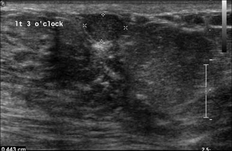 Gray-scale ultrasound image shows a well-circumscribed nodule.