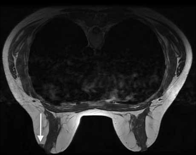 Axial T1 –weighted MR image at the level of the nipple demonstrates a small, well circumscribed nodule lateral to left nipple of intermediate signal.