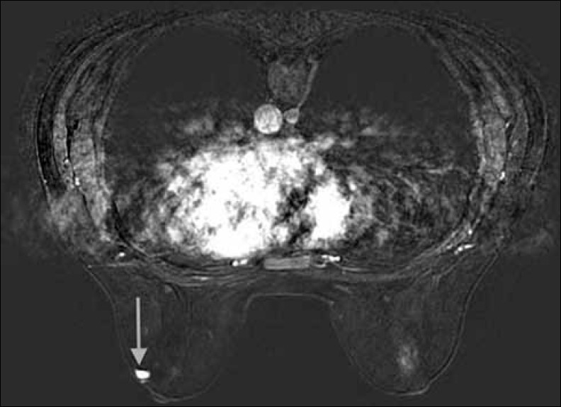 Dynamic, fat saturated magnetic resonance performed immediately after intravenous contrast administration at the same level as Figure 2 demonstrates avid enhancement of the lesion lateral to the left nipple.