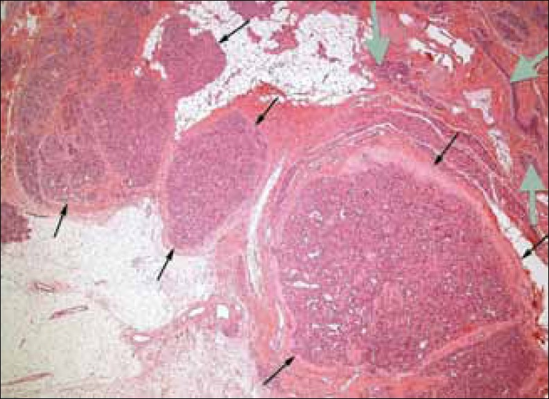 Hematoxylin and Eosin stained tissue at ×40 low power view shows hemangioma (black arrows) and breast ducts and lobules (gray arrows).