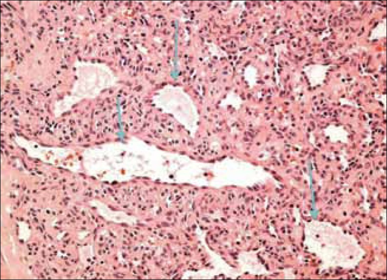 Hematoxylin and Eosin stained tissue at ×400 high power view reveals abnormal vascular spaces in the hemangioma (arrows).