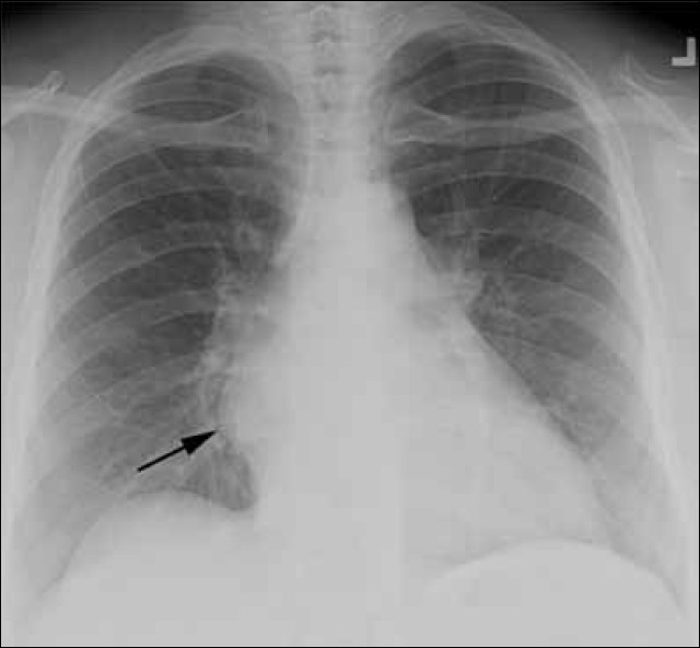 Multilocular thymic cyst with follicular hyperplasia in a 47- year-old HIV+ female with cough and chest pain. Postero-anterior chest radiograph demonstrates an abnormal contour along the right cardiomediastinal border (arrow).