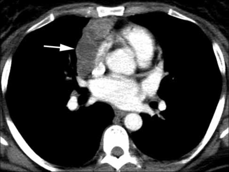 Multilocular thymic cyst with follicular hyperplasia in a 47 year-old HIV+ female with an anterior mediastinal mass. Axial contrast enhanced chest CT at the level of the heart shows a 7.1 × 2.7 × 8.8 cm lobular lowattenuation mass with heterogeneous enhancement draped across the anterior mediastinum (arrow).