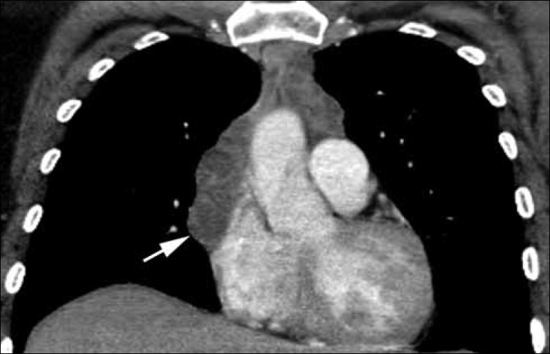 Multilocular thymic cyst with follicular hyperplasia in a 47 year-old HIV+ female with an anterior mediastinal mass. Coronal contrast enhanced chest CT shows low-attenuation cystic areas and enhancing septations (arrow).