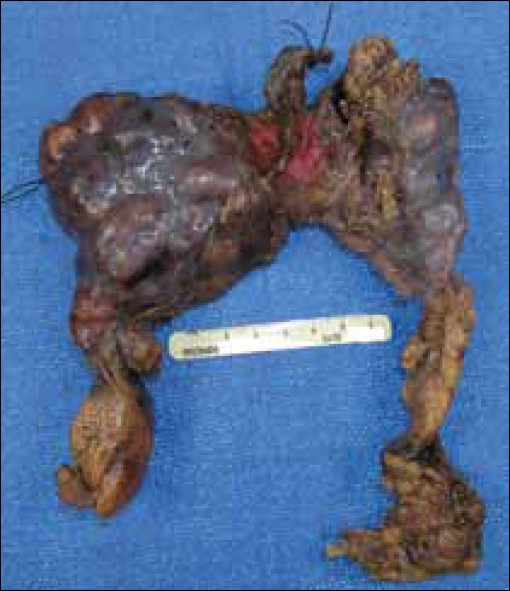 Multilocular thymic cyst with follicular hyperplasia. Gross thymectomy specimen from a 47- year-old HIV+ female weighs 180 gram and measures 14.5 cm from medial to lateral, 15 cm from superior to inferior and up to 3.5 cm from anterior to posterior. The gland is very lobulated in appearance with a moderate amount of attached adipose tissue. The gland appears encapsulated with a smooth and glistening pink-purple surface.