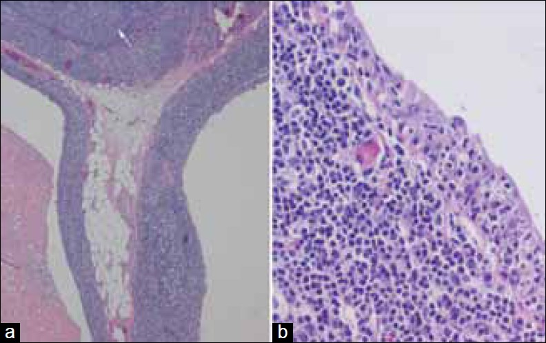 Multilocular thymic cyst with follicular hyperplasia. Hematoxylin and Eosin staining of thymectomy specimen from a 47 year-old HIV+ female shows (a) Two adjacent cysts (left and right) and a large lymphoid follicle with a germinal center (arrow) (2×). (b) Cyst wall with columnar epithelium heavily infiltrated by lymphocytes (20×).