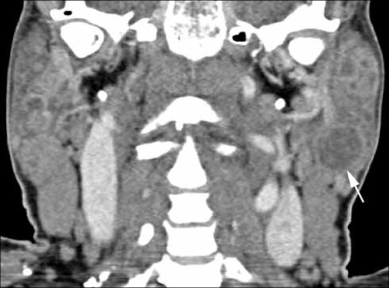 Benign lymphoepithelial cysts in a 47- year-old HIV+ female with bilaterally enlarged parotid glands. Coronal contrast enhanced neck CT demonstrates innumerable hypo dense foci, the largest one measuring 1.8 cm in the tail of the left parotid (arrow).