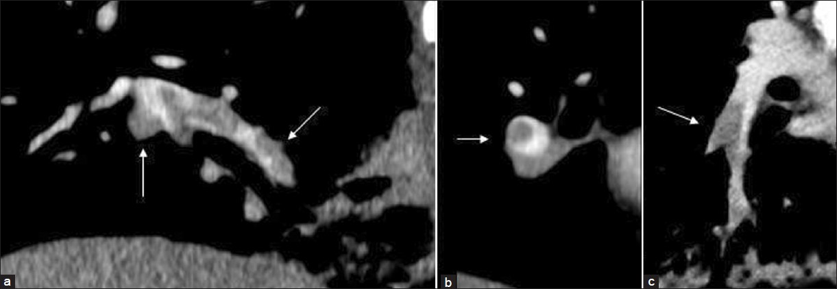 Computed tomography pulmonary angiography with a flow rate of 2.0 mL/s in a patient with suspected pulmonary embolism. Different reformations (a,b and c) clearly show pulmonary emboli (arrows) in the right lower lobe.