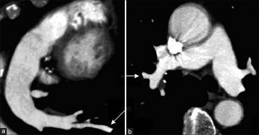 Computed tomography pulmonary angiography in two different patients with suspected pulmonary embolism. (a) With a flow rate of 2.5 mL/s and (b) with flow rate of 2.0 mL/s, Good vascular enhancement can be seen even in more peripheral vessels (arrows).