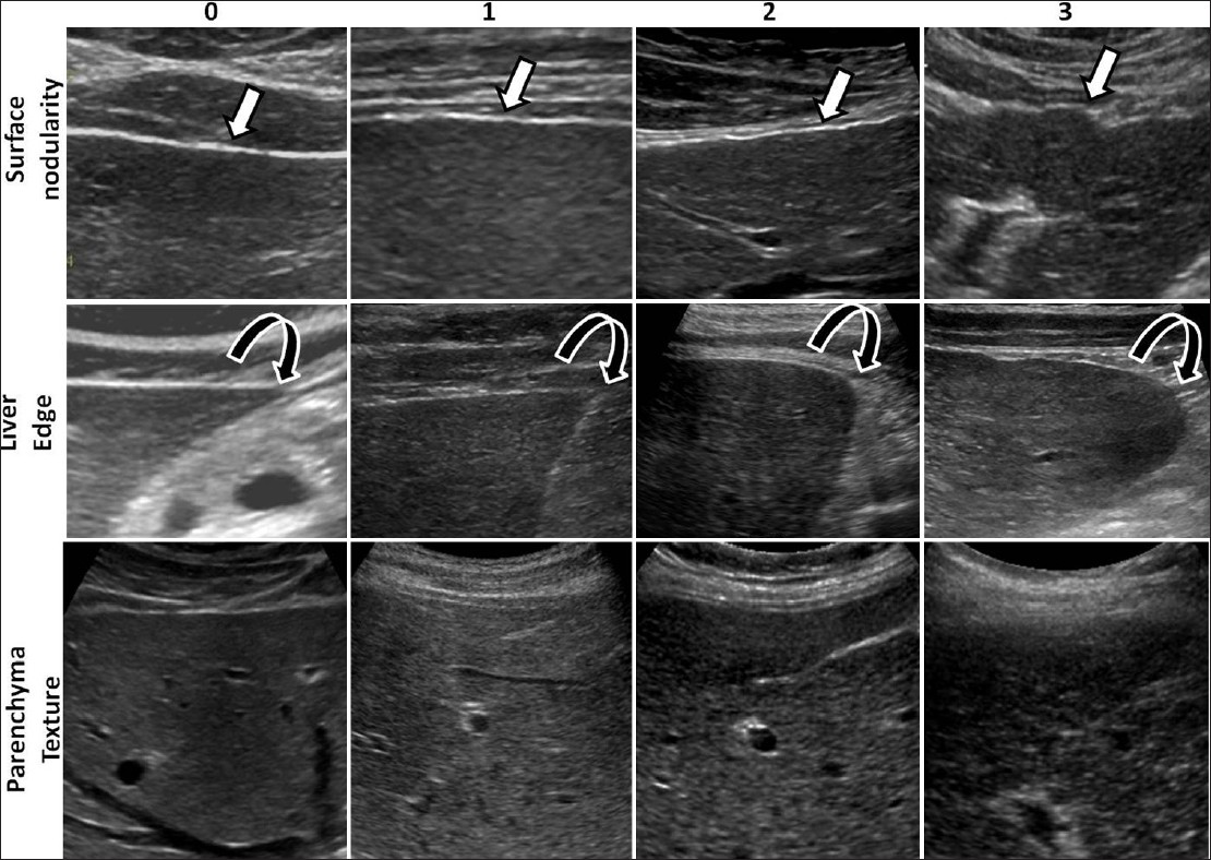 Accuracy of Routine Clinical Ultrasound for Staging of Liver Fibrosis ...