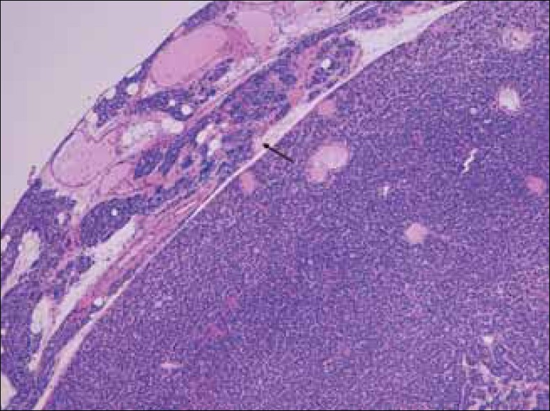 Hematoxylin-Eosin stain at 10x shows enlarged parathyroid gland composed mainly of chief cells, without stromal fat, and a rim of normal parathyroid tissue (arrow).