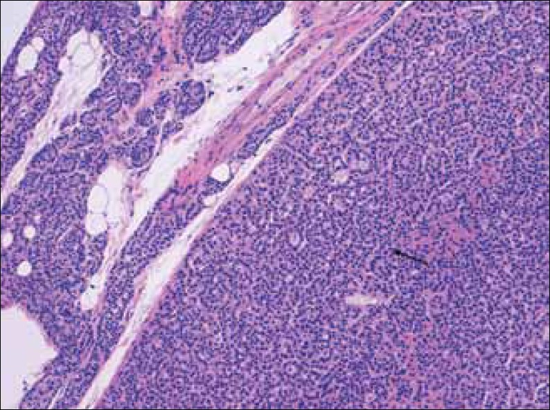 Hematoxylin-Eosin stain at 20x shows enlarged parathyroid gland composed mainly of chief cells, without stromal fat (arrow), and a rim of normal parathyroid tissue.