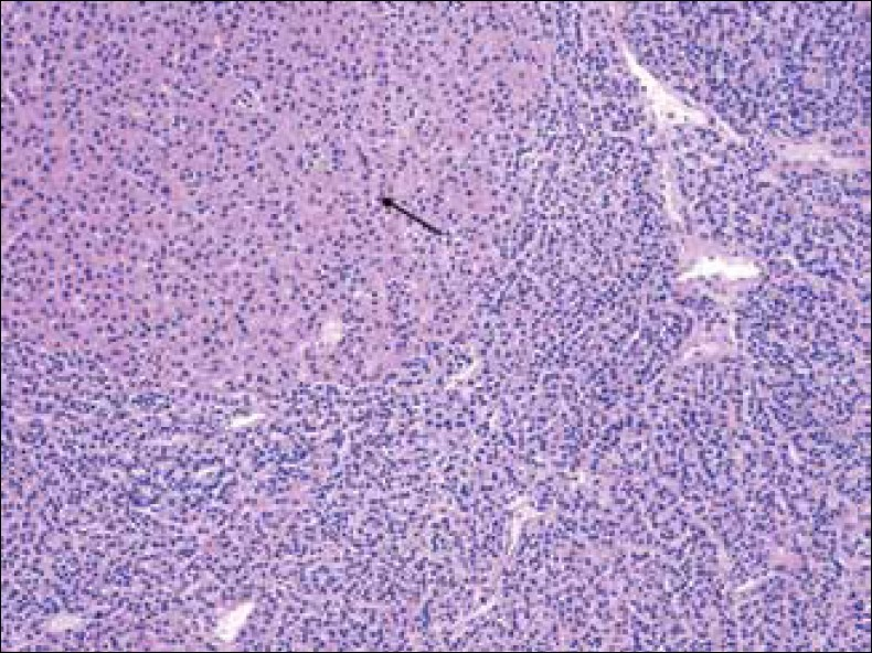 Hematoxylin-Eosin stain at 20x shows parathyroid gland with chief cell hyperplasia and oncocytic cells (arrow).