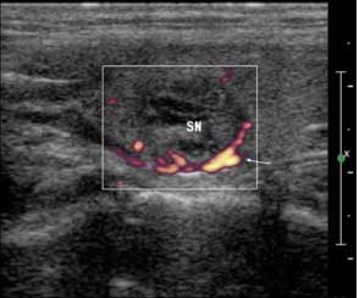 Longitudinal ultrasound image of a 3-cm oval-shaped, multiloculated nodule in the upper parathyroid. Power-Doppler shows peripheral pattern of vascularity (white arrow).
