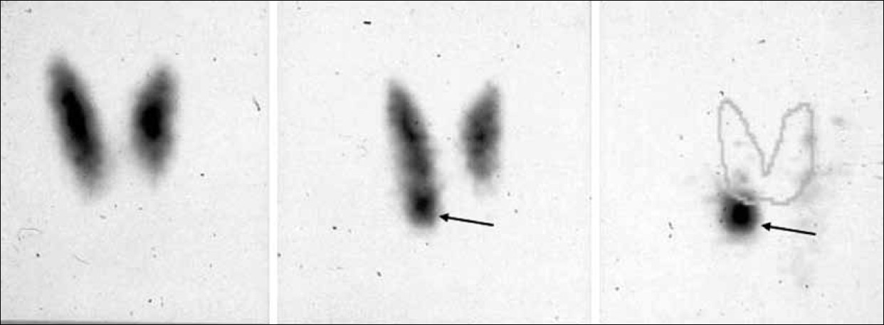 Example of parathyroid scintigraphy according to the dual-tracer protocol (99m-Tc-pertechnetate and 99mTc-sestamibi). (On the left) the 99 mTc-pertechnetate scan shows a normal thyroid gland. (In the center) the 99mTc-sestamibi scan suggests the presence of adenoma of the lower right parathyroid glaand (arrow), better outlined when subtracting the 99mTc-pertechnetate scan from the summation scan (arrow).