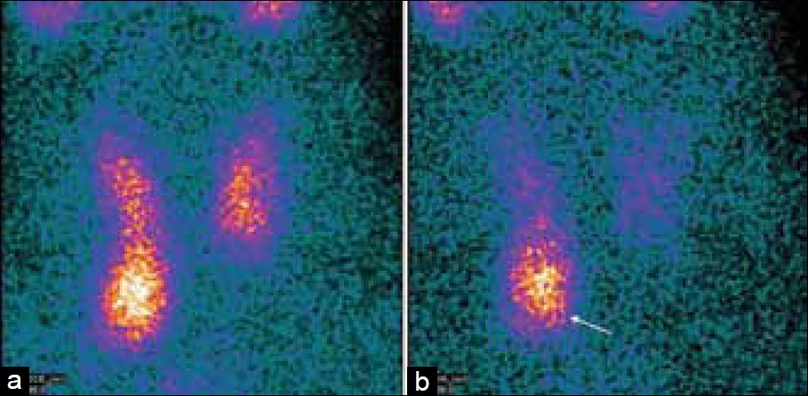 Differential wash-out of 99mTc-Sestamibi between the normal thyroid gland and parathyroid adenoma. Early images (a) demonstrate the physiological uptake of 99mTc-sestamibi throughout the thyroid gland, which washes out the delayed images. (b) There is a persistent focus on the uptake, inferior to the right lower pole of the thyroid gland, on the early and delayed images (white arrow), which represents a parathyroid adenoma.