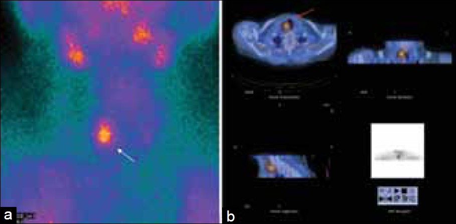 This figure demonstrates the importance of SPECT / CT for determining the relationship of the parathyroid adenomas with the adjacent structures. (a) Patient with previous thyroidectomy, a focus of uptake is seen in the right cervical area (white arrow). (b) SPECT / CT images localize this focus (red arrow) to the right paratracheal region. At surgery, this was determined to be a true right inferior parathyroid adenoma.