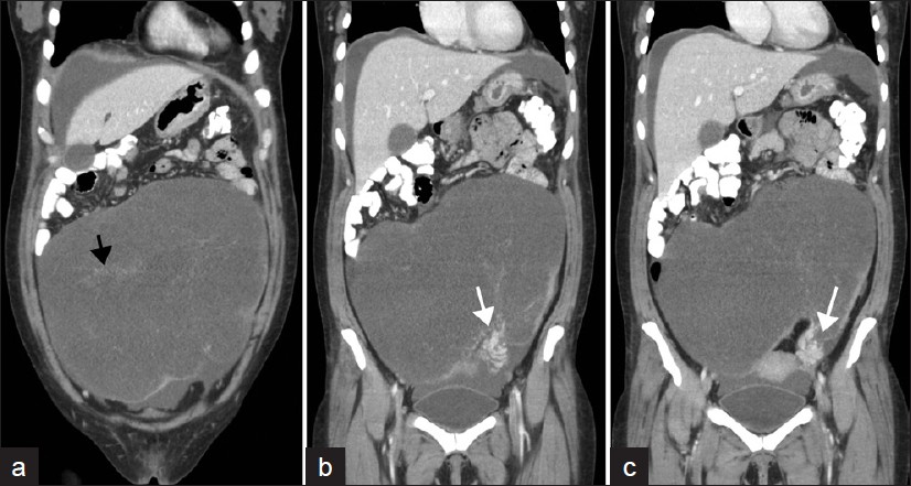 Contrast-enhanced coronal CT images of the abdomen and pelvis, demonstrate a large predominantly cystic left adnexal mass containing multiple septations almost completely occupying the abdomen (black arrow). The twisted vascular pedicle in the left lower quadrant demonstrates a whirlpool sign (white arrows) (similar to what is described in the ultrasound literature).