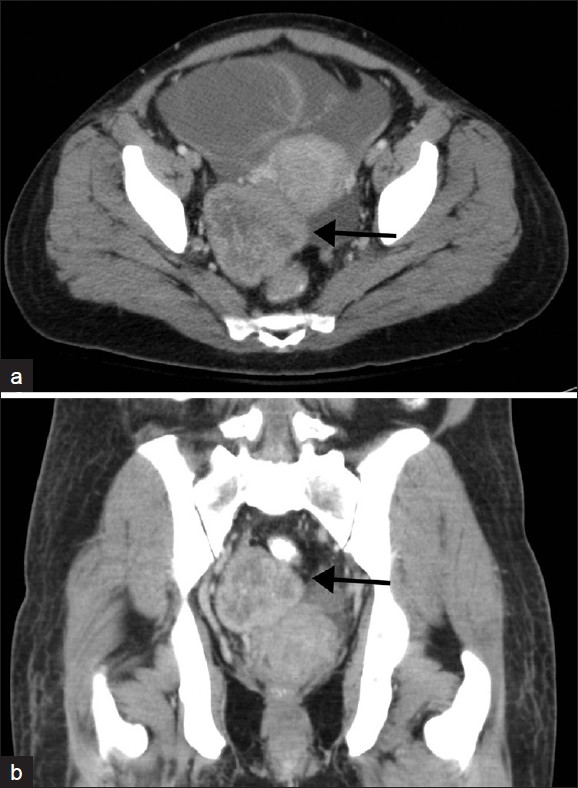 (a) Contrast-enhanced axial and (b) coronal CT images through the pelvis demonstrate a solid heterogeneously enhancing right-adnexal mass, with a thick enhancing rind, consistent with a Krukenberg Tumor (arrow).